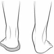foot pronation with and without orthotic