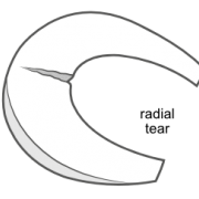 radial meniscus tear