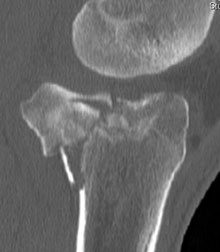 tibial plateau fracture pre-op