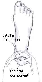 patellar resurfacing