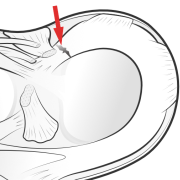 root tear of the meniscus