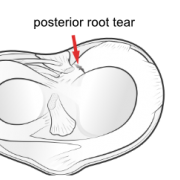 posterior meniscus root tear