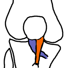 Image of roux-goldthwait procedure