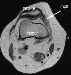 MPFL rupture