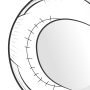 meniscal scaffold sewn into place