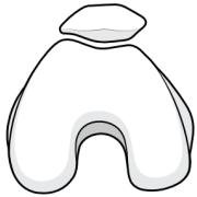 mild trochlear dysplasia with shallow trochlea