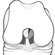 torn cruciate ligament