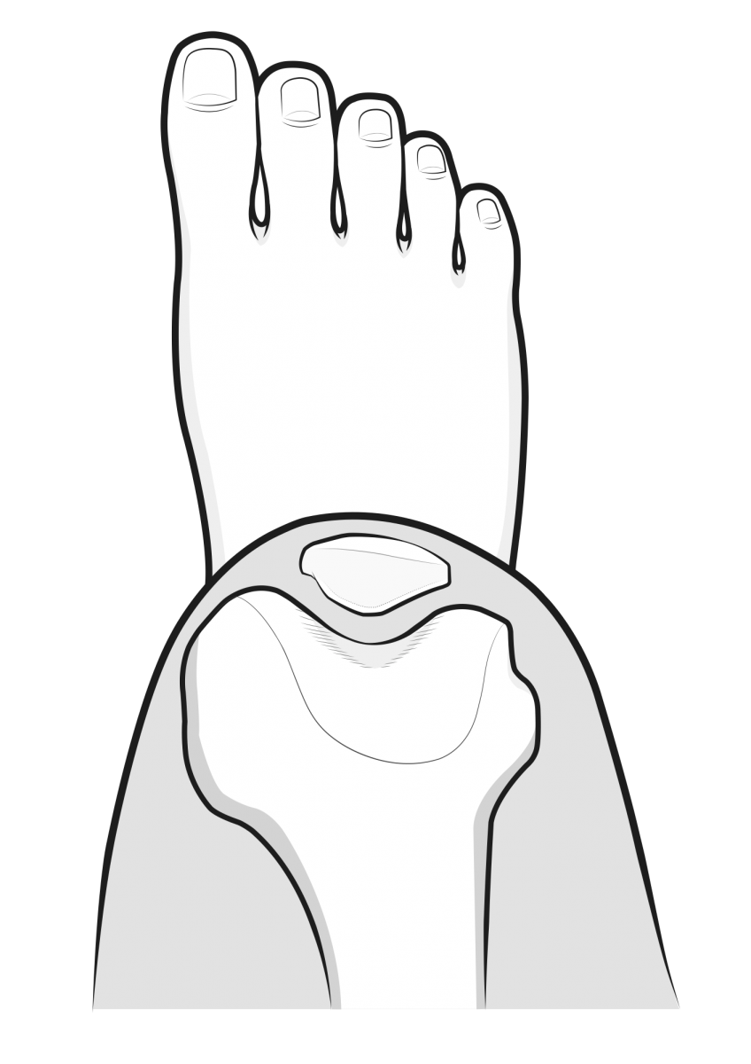 patella from above