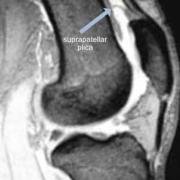 Arrow pointing to the suprapatellar plica