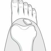 subluxaton of the patella seen from above
