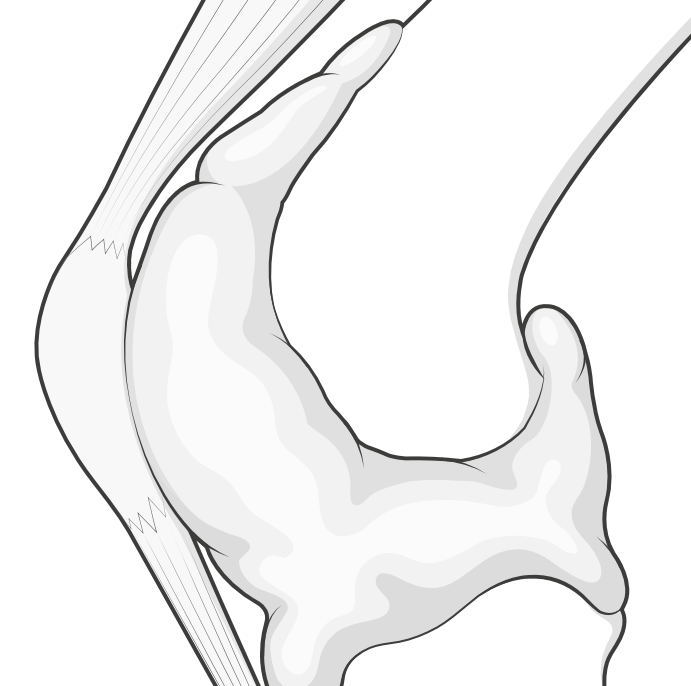 knee capsule swollen with haemarthrosis