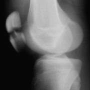 patellar fracture