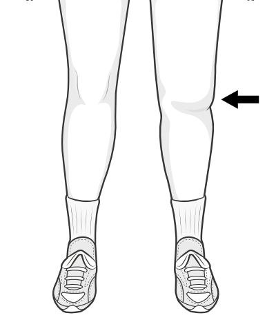 swollen knee and haemarthrosis