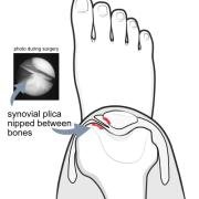 synovial plica being nipped