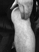 Photo showing site of pain in patellar tendinitis