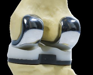 tibial and femoral components from back