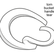 torn bucket handle tear of meniscus