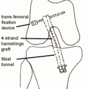 femoral transfixation