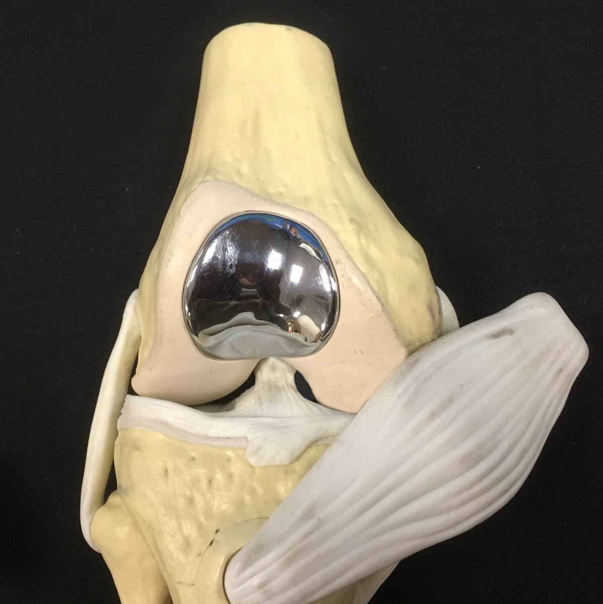 trochlear resurfacing