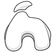 trochlear dysplasia with a trochlear bump