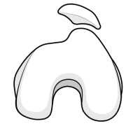 trochlear dysplasia with trochlear bump