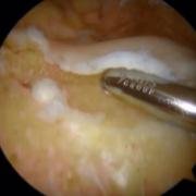 arthroscopic trochleoplasty - reducing the 'bump'