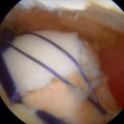 arthroscopic trochleoplasty with tapes