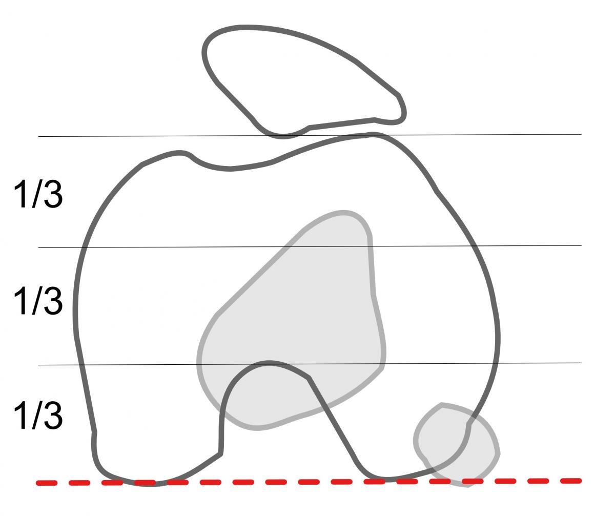 TT-TG rule of thirds