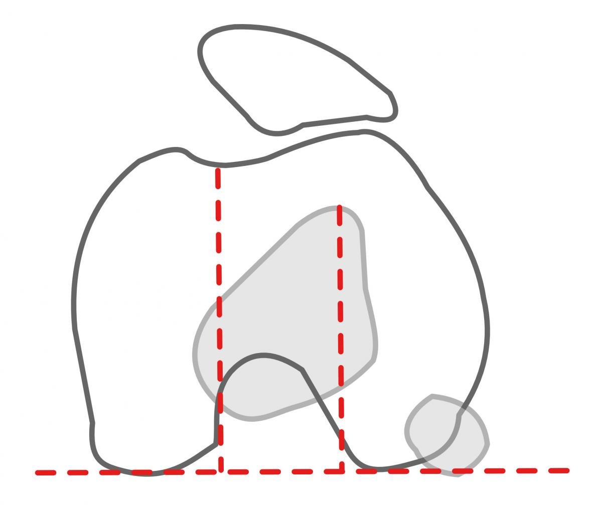 TT-TG trochlear dysplasia