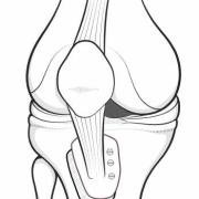 tibial tubercle osteotomy