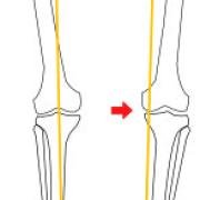 varus deformity in one knee