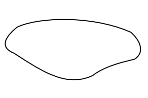 Wiberg Type 1 patella