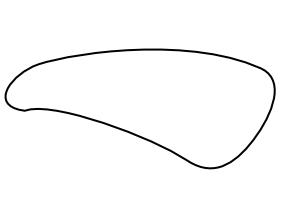 Wiberg Type 3 patella